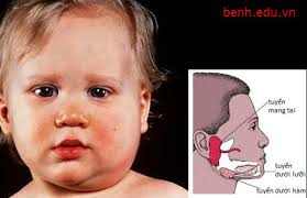 Một số bài thuốc đơn giản chữa quai bị