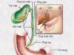 Bài thuốc trị Sỏi mật