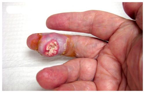 Biến chứng đáng sợ của bệnh Gout