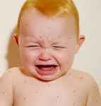 Bài thuốc dân gian chữa chốc lở cho trẻ hiệu quả