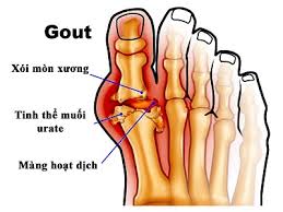 Bài thuốc chữa bệnh GÚT (GOUTE)