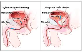 Đông y chữa Phì đại tuyến tiền liệt
