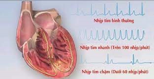 Bài thuốc chữa trị nhịp tim chậm