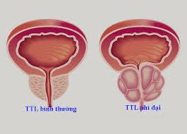 Bài thuốc chữa Phì đại tuyến tiền liệt