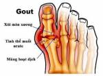 Bài thuốc chữa bệnh GÚT (GOUTE)