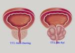 Bài thuốc chữa Phì đại tuyến tiền liệt